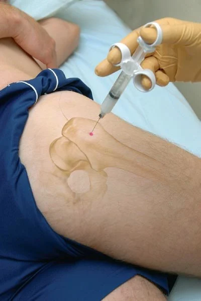 Shockwave therapy for selected shoulder tendon problems at Physio Tullamore