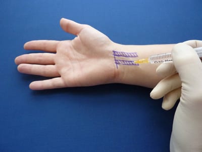 Shockwave therapy for selected shoulder tendon problems at Physio Tullamore