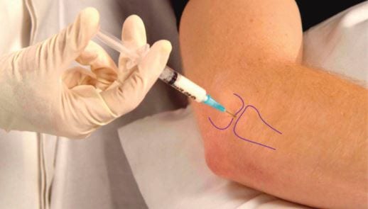 Shockwave therapy for hip pain and greater trochanteric pain syndrome at Physio Tullamore