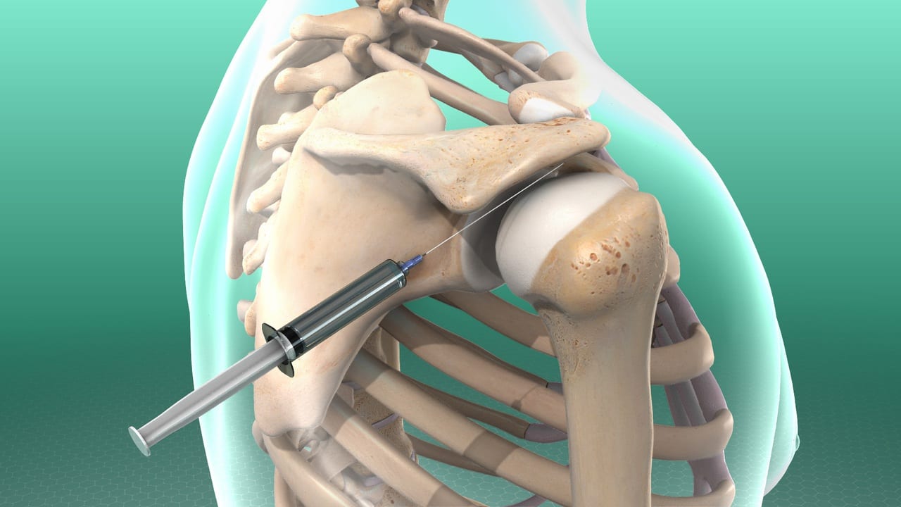 Shockwave therapy for tennis elbow at Physio Tullamore