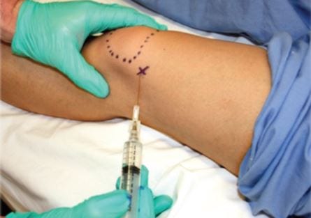 Shockwave therapy for hip pain and greater trochanteric pain syndrome at Physio Tullamore