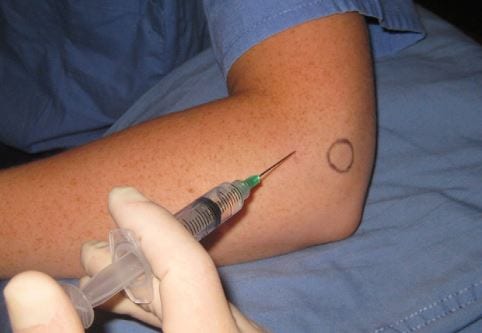 Shockwave therapy for selected shoulder tendon problems at Physio Tullamore