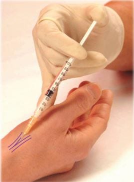 Shockwave therapy for hip pain and greater trochanteric pain syndrome at Physio Tullamore