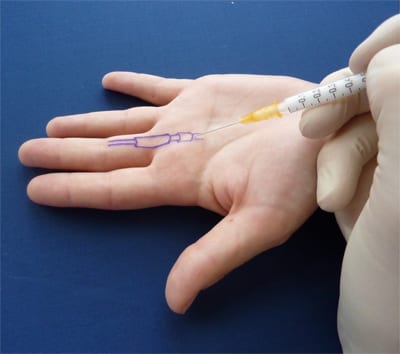 Shockwave therapy for tennis elbow at Physio Tullamore