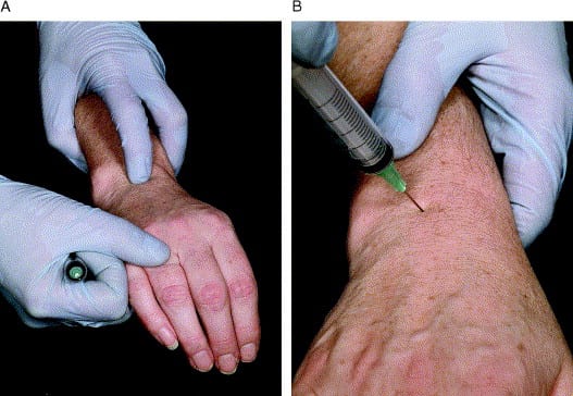 Shockwave therapy for tennis elbow at Physio Tullamore