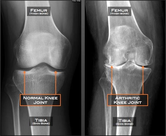 Knee osteoarthritis