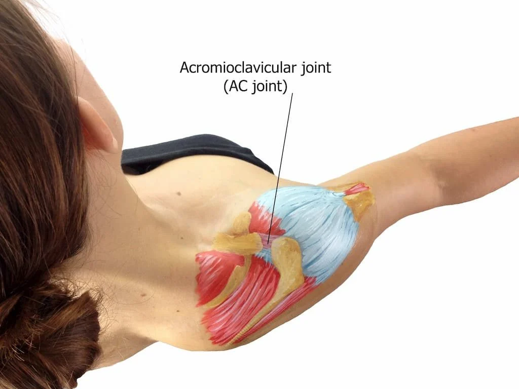 ACJ sprain treatment at Physio Tullamore