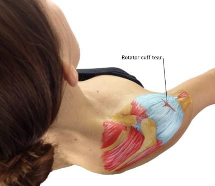Rotator cuff tendinopathy rehabilitation at Physio Tullamore