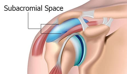 Shoulder impingement treatment at Physio Tullamore
