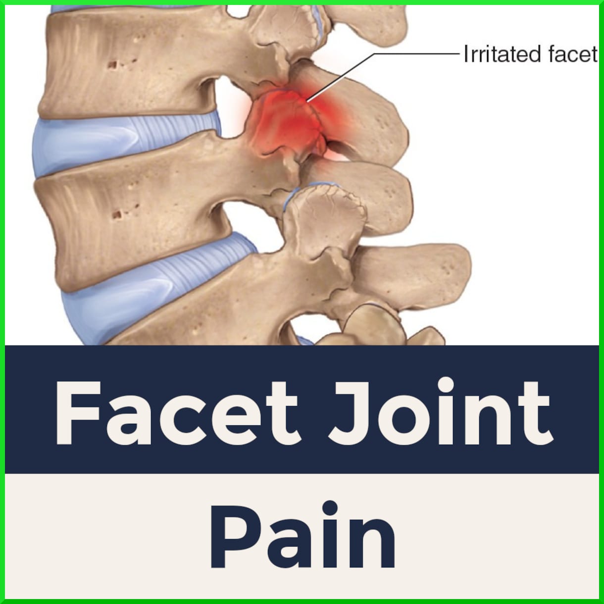 Facet joint pain treatment at Physio Tullamore