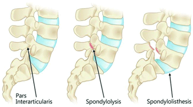 Lumbar stress fractures and pars defect management for athletes at Physio Tullamore