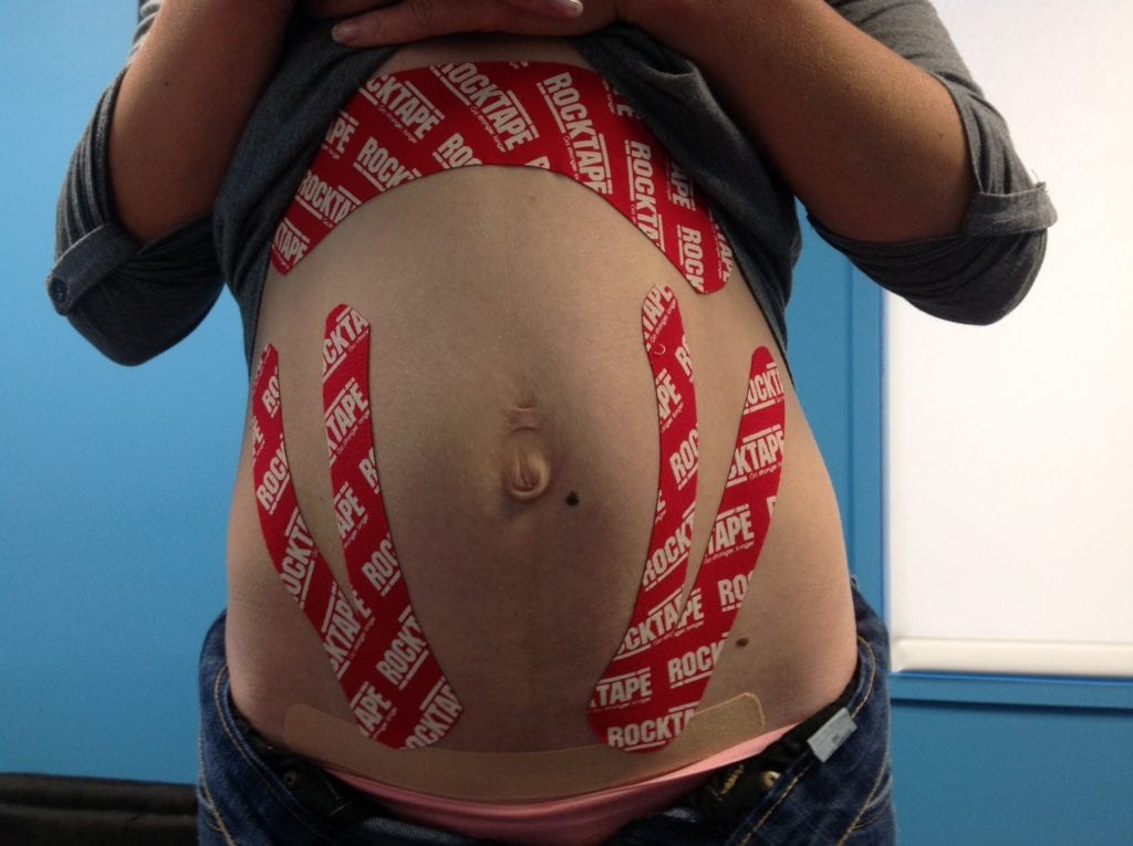 Kinesiology taping for pregnancy-related back pain